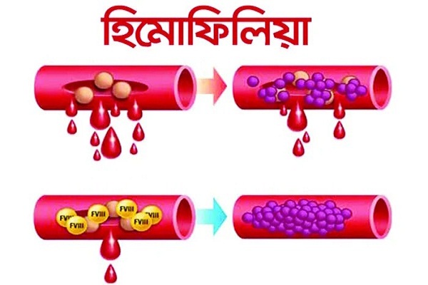 হিমোফিলিয়া: সম্মুখ ধারণা থাকা জরুরী